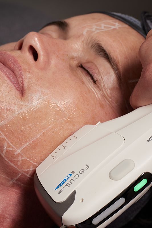 Tratamiento de Hifu en el rostro, mujer con los ojos cerrados